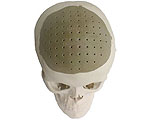 3D Printed Skull Implant