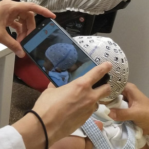 App and Cranial Cap Analyze Infant Head Deformaties