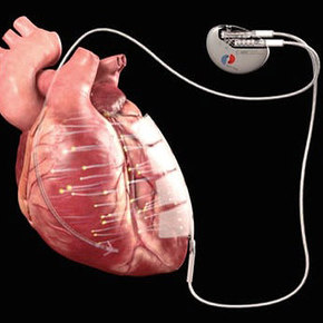 C-MIC Implant Heals the Heart with Electricity