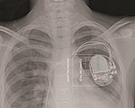 First Fully-Implantable Fetal Pacemaker