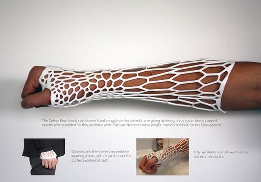 3D-Printed Cast Improves Comfort and Reduces Waste