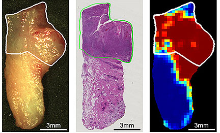 Hyperspectral Microscope Sees Cancerous Tissue