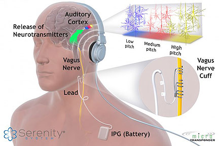 Vagus Nerve Stimulation Relieves Tinnitus