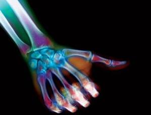 3-D Printer Creates a Complete Thumb Bone