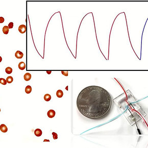 Sensor Monitors Sickle Cell with Electrical Impedance