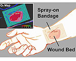 Smart Bandage Helps Physicians Monitor Wounds