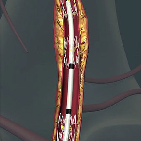 Tack Endovascular System Patches Torn Vessels