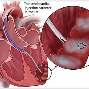 VentriGel Heart-Healing Hydrogel