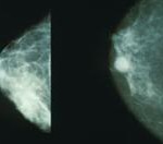 Can Crowdsourcing Revolutionise Breast Cancer Research?