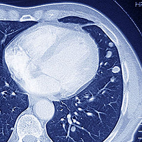 AI Learns to Target Tumors for Radiation