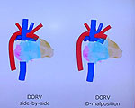 3D Heart Models Simplify Medical Explanations