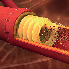 3D-Printed Sugary Stent Holds Arteries for Suturing