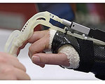 Affordable, 3D-Printed Hand Healing Therapy