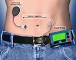 Artificial Pancreas controls Diabetes Automatically