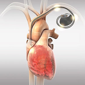 BackBeat Implant Treats High Blood Pressure
