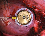 Battery-Free Pacemaker Based on Wristwatch Technology
