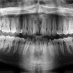 Biomaterial Filling Could Reduce Root Canals