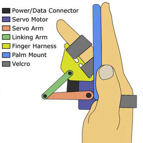 BiRD Device Gives Parkinson's the Finger