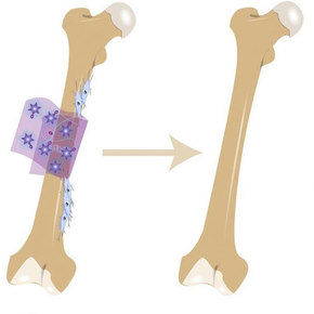 Bone Bandage Speeds Healing