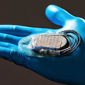Cellulose Pouch Eases Pacemaker Replacement