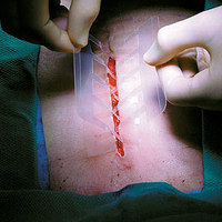 CloseX Bandages Replace Needles and Sutures