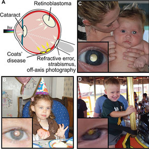 CRADLE App Detects Eye Diseases in Children