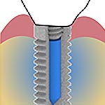 Dental Implant Fights Infections