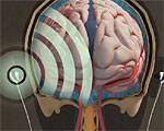 Earbuds Monitor Cranial Pressure Non-Invasively