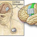 Electrical Stimulation Eases Seizures