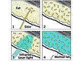 Gold Nanoparticles Make Liposuction Safer
