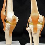 Hydrogel Aids in Knee Repair
