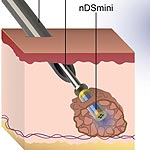 Implantable Drug Delivery Device Can Target Tumors