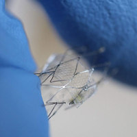 Implantable Sensor Monitors Aneurysm Treatment