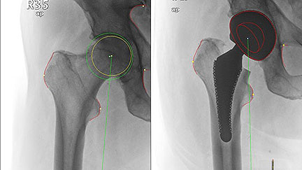 Artifical Hip Adjusts for a Better Fit