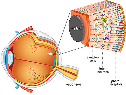 Artifical Retina Stays Cool