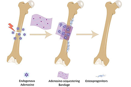 Bone Bandage Speeds Healing