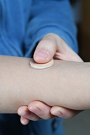 Microneedle Contraceptive Patch Last for One Month