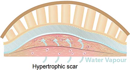 Smart Scar-Care Pad Reduces Scarring Two Ways