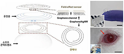 Soft Contact Lens Monitors Glucose and Glaucoma