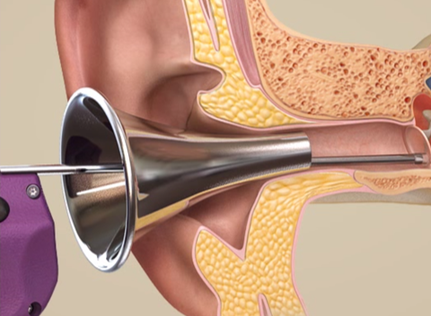 Tula System Allows Awake Ear Tube Placement