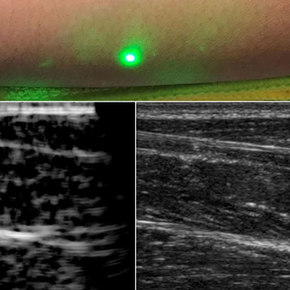 Laser-Based Ultrasound Images from a Distance