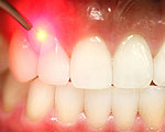 Laser Therapy Encourages Tooth Repair