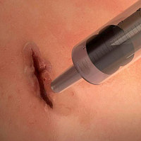 MeTro Adhesive Seals Wounds in Seconds