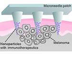 Microneedles Help Target Melanoma