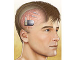 NeuroPace RNS System Prevents Seizures Before They Start