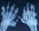 New Technique Promises Rheumatoid Arthritis Treatment