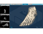PeekMed One Lets Orthopedic Surgeons Plan Surgeries in 3D
