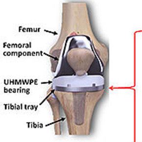 Self-Powered Smart Knee Implant Reduces Surgeries