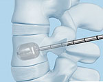 SYNFLATE Vertebral Balloons Help Repair Compression Fractures