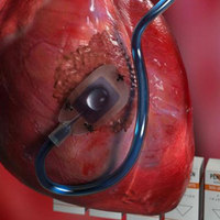Therepi Delivers Medication Directly to the Heart